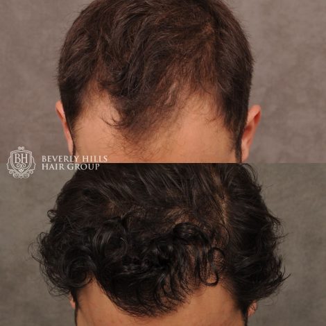 male patient before and after a combination of a FUE hair transplant and PRP treatment