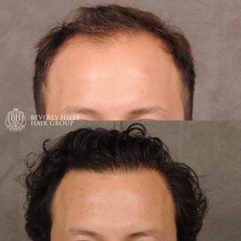 male patient before and after a combination of a FUE hair transplant and PRP treatment