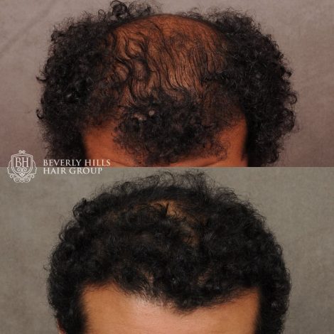 patient before and after hair procedure