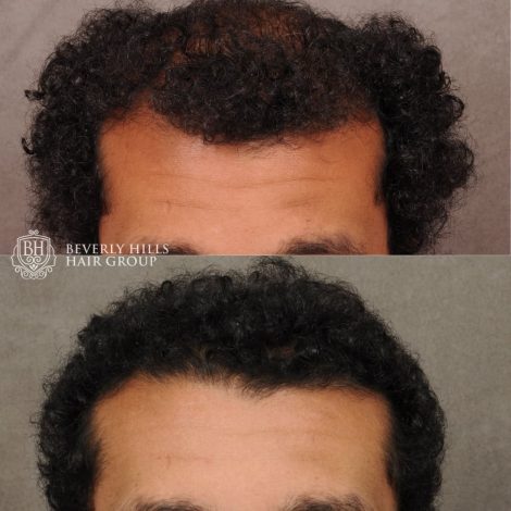 patient before and after hair procedure