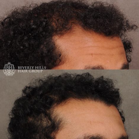 patient before and after hair procedure