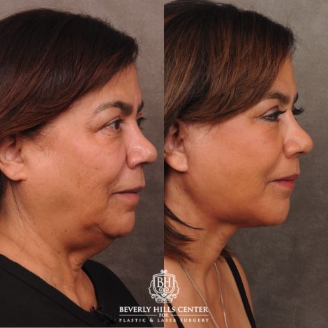 Beverly Hills Center Female Patient Before and After Comprehensive AuraLyft, CUPID LIFT®, Brow Lift, Upper Blepharoplasty