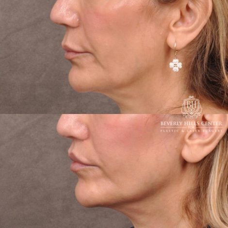 Beverly Hills Center Female Patient Before and After CUPID LIFT® Corner Lift