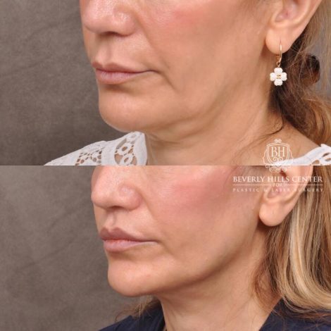 Beverly Hills Center Female Patient Before and After CUPID LIFT® Corner Lift