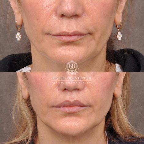 Beverly Hills Center Female Patient Before and After CUPID LIFT® Corner Lift
