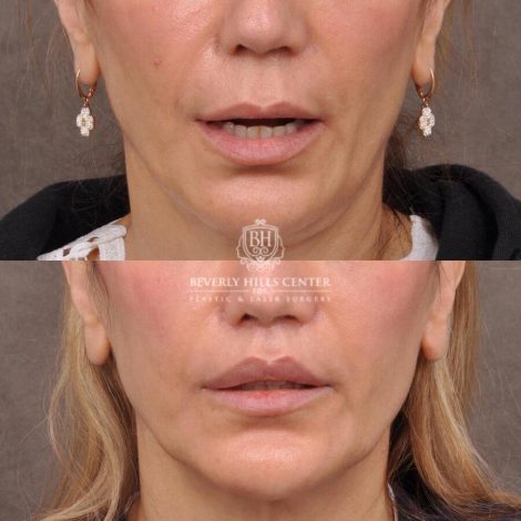 Beverly Hills Center Female Patient Before and After CUPID LIFT® Corner Lift