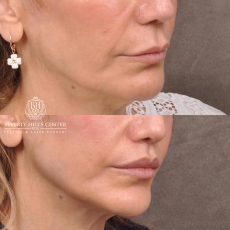Beverly Hills Center Female Patient Before and After CUPID LIFT® Corner Lift