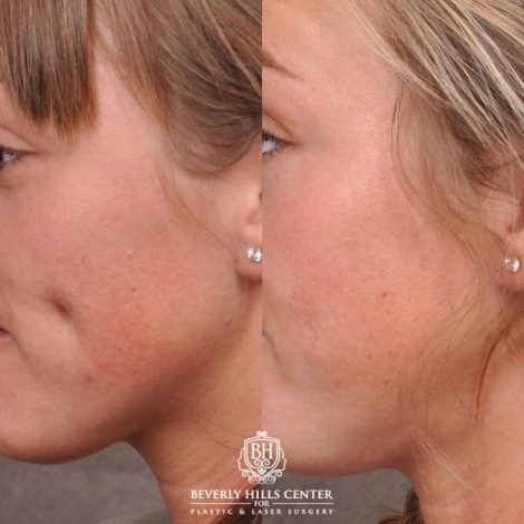 Beverly Hills Center Female Patient Before and After Cheek Reconstituted