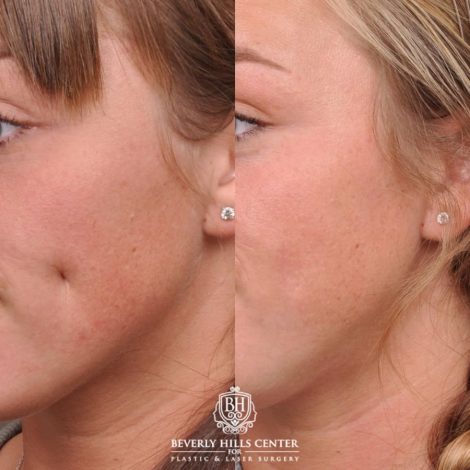 Beverly Hills Center Female Patient Before and After Cheek Reconstituted