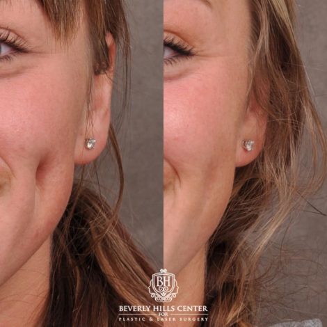 Beverly Hills Center Female Patient Before and After Cheek Reconstituted