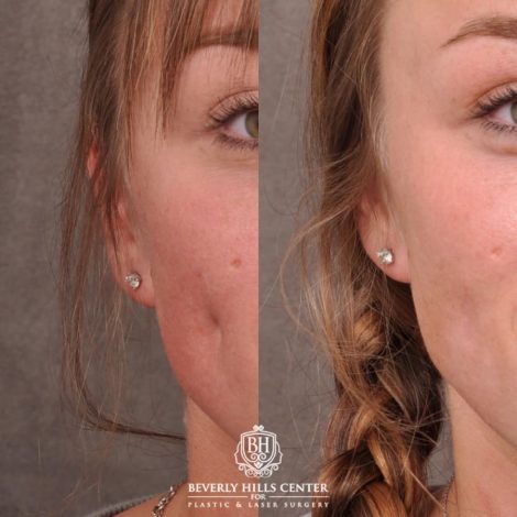 Beverly Hills Center Female Patient Before and After Cheek Reconstituted