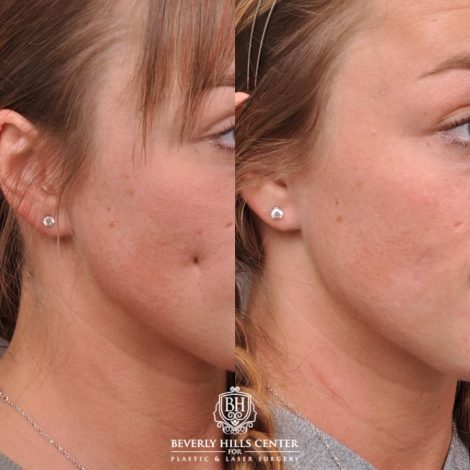 Beverly Hills Center Female Patient Before and After Cheek Reconstituted