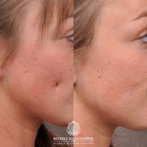 Beverly Hills Center Female Patient Before and After Cheek Reconstituted