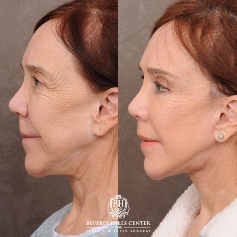 Beverly Hills Center Female Patient Before and After Revision AuraLyft, CUPID LIFT® Lip Lift, Brow Repositioning
