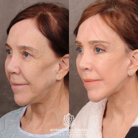 Beverly Hills Center Female Patient Before and After Revision AuraLyft, CUPID LIFT® Lip Lift, Brow Repositioning
