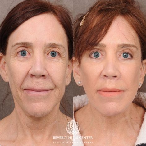 Beverly Hills Center Female Patient Before and After Revision AuraLyft, CUPID LIFT® Lip Lift, Brow Repositioning