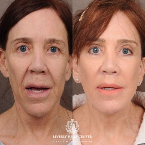 Beverly Hills Center Female Patient Before and After Revision AuraLyft, CUPID LIFT® Lip Lift, Brow Repositioning