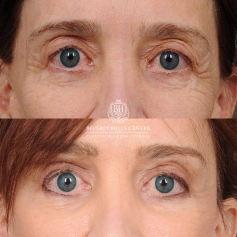 Beverly Hills Center Female Patient Before and After Revision AuraLyft, CUPID LIFT® Lip Lift, Brow Repositioning