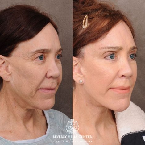 Beverly Hills Center Female Patient Before and After Revision AuraLyft, CUPID LIFT® Lip Lift, Brow Repositioning