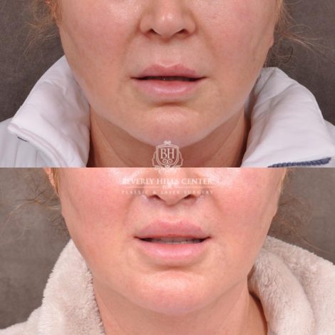 Beverly Hills Center Female Patient Before and After Lip Lift, Profound, Botox, Laser