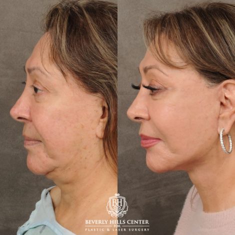 Beverly Hills Center Female Patient Before and After Revision AuraLyft, Neck Lift, Buccal Fat Grafting