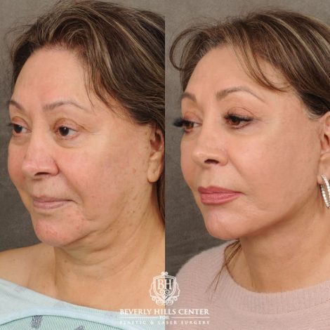 Beverly Hills Center Female Patient Before and After Revision AuraLyft, Neck Lift, Buccal Fat Grafting