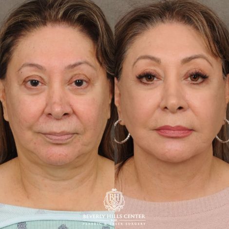 Beverly Hills Center Female Patient Before and After Revision AuraLyft, Neck Lift, Buccal Fat Grafting