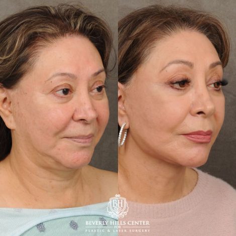 Beverly Hills Center Female Patient Before and After Revision AuraLyft, Neck Lift, Buccal Fat Grafting