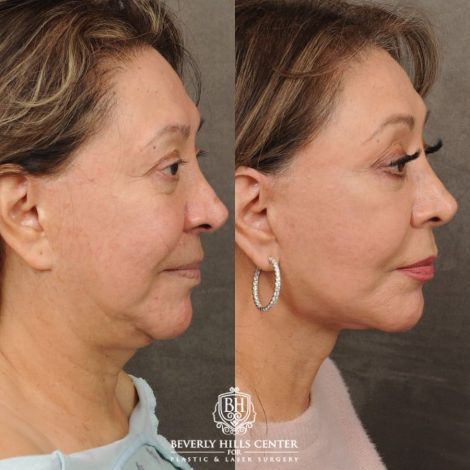 Beverly Hills Center Female Patient Before and After Revision AuraLyft, Neck Lift, Buccal Fat Grafting