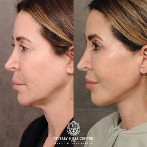 Beverly Hills Center Female Patient Before and After AuraLyft, Upper Blepharoplasty, CUPID LIFT®