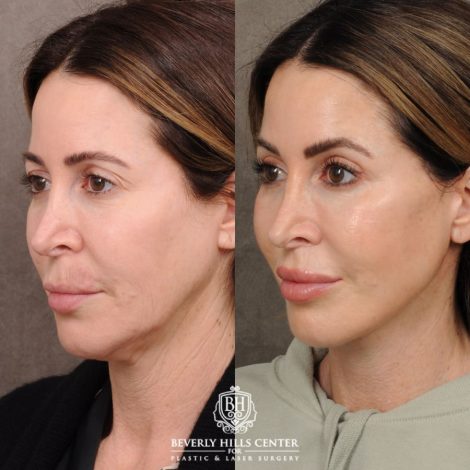Beverly Hills Center Female Patient Before and After AuraLyft, Upper Blepharoplasty, CUPID LIFT®