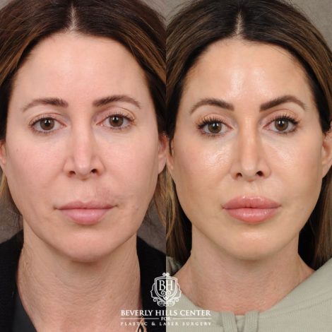 Beverly Hills Center Female Patient Before and After AuraLyft, Upper Blepharoplasty, CUPID LIFT®
