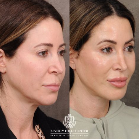 Beverly Hills Center Female Patient Before and After AuraLyft, Upper Blepharoplasty, CUPID LIFT®