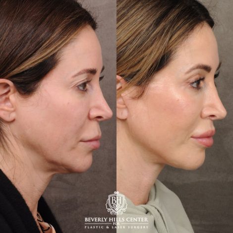 Beverly Hills Center Female Patient Before and After AuraLyft, Upper Blepharoplasty, CUPID LIFT®
