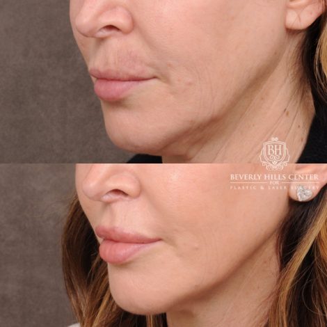 Beverly Hills Center Female Patient Before and After AuraLyft, Upper Blepharoplasty, CUPID LIFT®