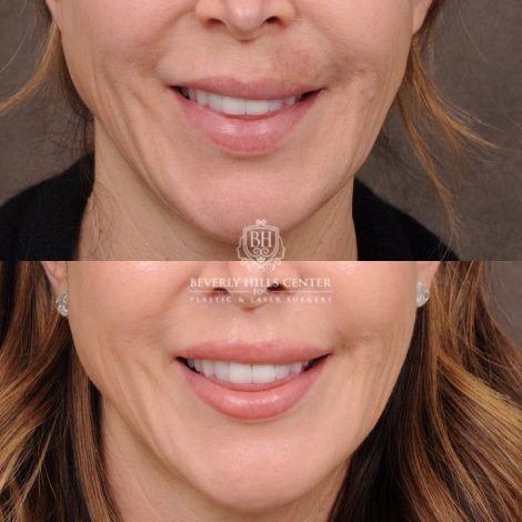 Beverly Hills Center Female Patient Before and After AuraLyft, Upper Blepharoplasty, CUPID LIFT®