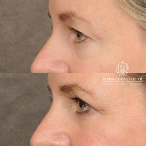 Beverly Hills Center Female Patient Before and After Upper & Lower Blepharoplasty, CUPID LIFT® Corner Lift