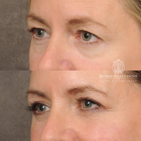 Beverly Hills Center Female Patient Before and After Upper & Lower Blepharoplasty, CUPID LIFT® Corner Lift