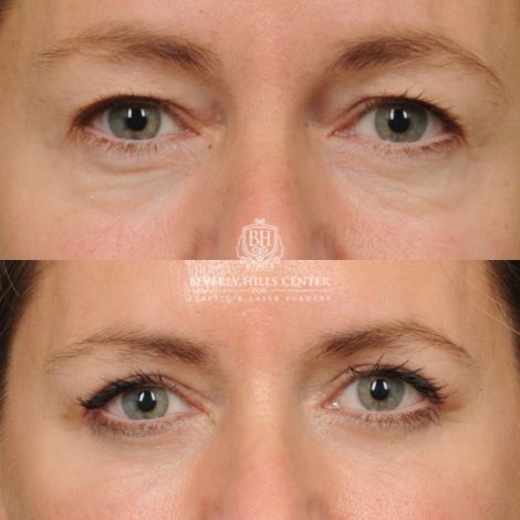 Beverly Hills Center Female Patient Before and After Upper & Lower Blepharoplasty, CUPID LIFT® Corner Lift