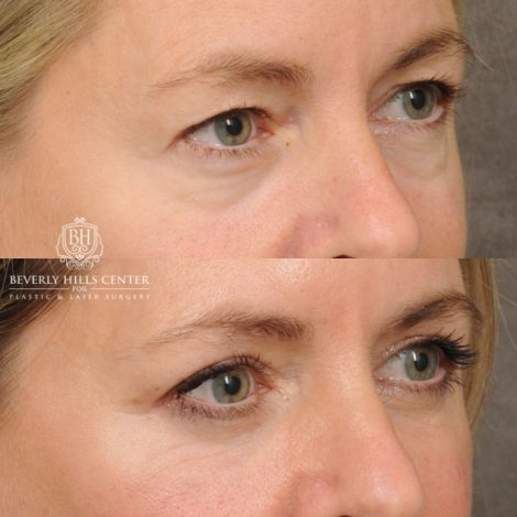 Beverly Hills Center Female Patient Before and After Upper & Lower Blepharoplasty, CUPID LIFT® Corner Lift
