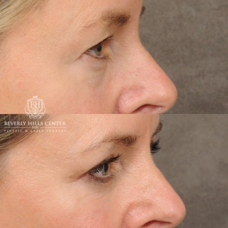 Beverly Hills Center Female Patient Before and After Upper & Lower Blepharoplasty, CUPID LIFT® Corner Lift