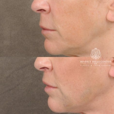 Beverly Hills Center Female Patient Before and After CUPID LIFT® Lip Lift