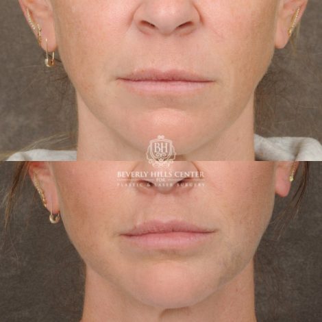 Beverly Hills Center Female Patient Before and After CUPID LIFT® Lip Lift