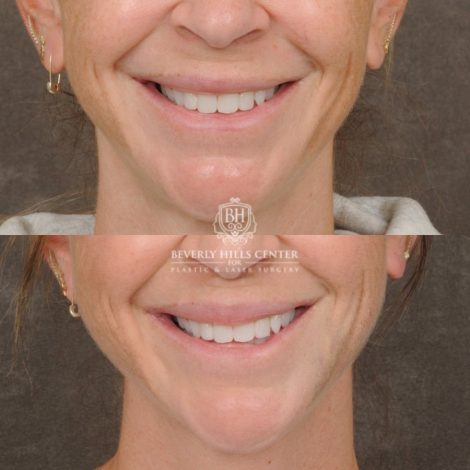 Beverly Hills Center Female Patient Before and After CUPID LIFT® Lip Lift