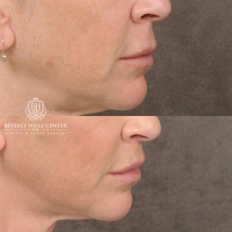 Beverly Hills Center Female Patient Before and After CUPID LIFT® Lip Lift