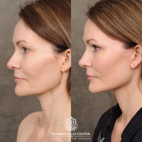 Beverly Hills Center Female Patient Before and After Revision AuraLyft, Upper & Lower Blepharoplasty