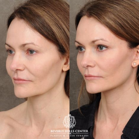 Beverly Hills Center Female Patient Before and After Revision AuraLyft, Upper & Lower Blepharoplasty