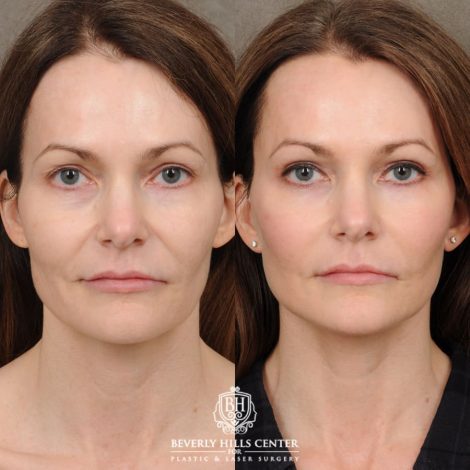Beverly Hills Center Female Patient Before and After Revision AuraLyft, Upper & Lower Blepharoplasty