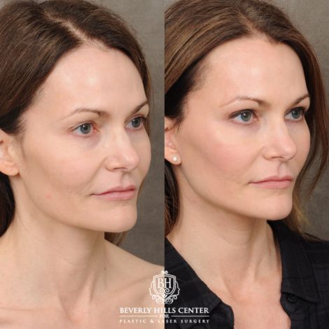 Beverly Hills Center Female Patient Before and After Revision AuraLyft, Upper & Lower Blepharoplasty