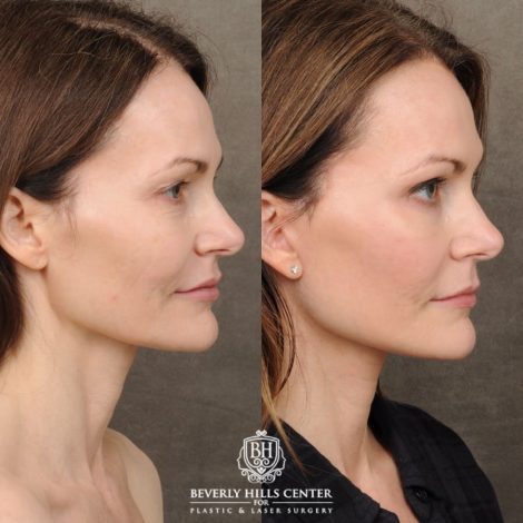 Beverly Hills Center Female Patient Before and After Revision AuraLyft, Upper & Lower Blepharoplasty